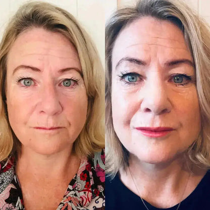 LIPBOOST | Microneedling Lèvres