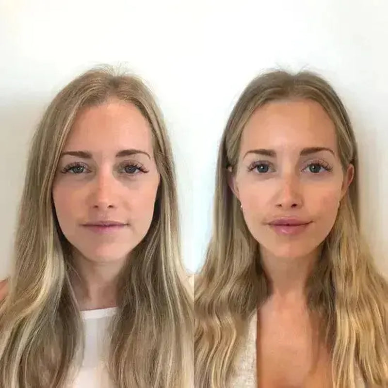 LIPBOOST | Microneedling Lèvres